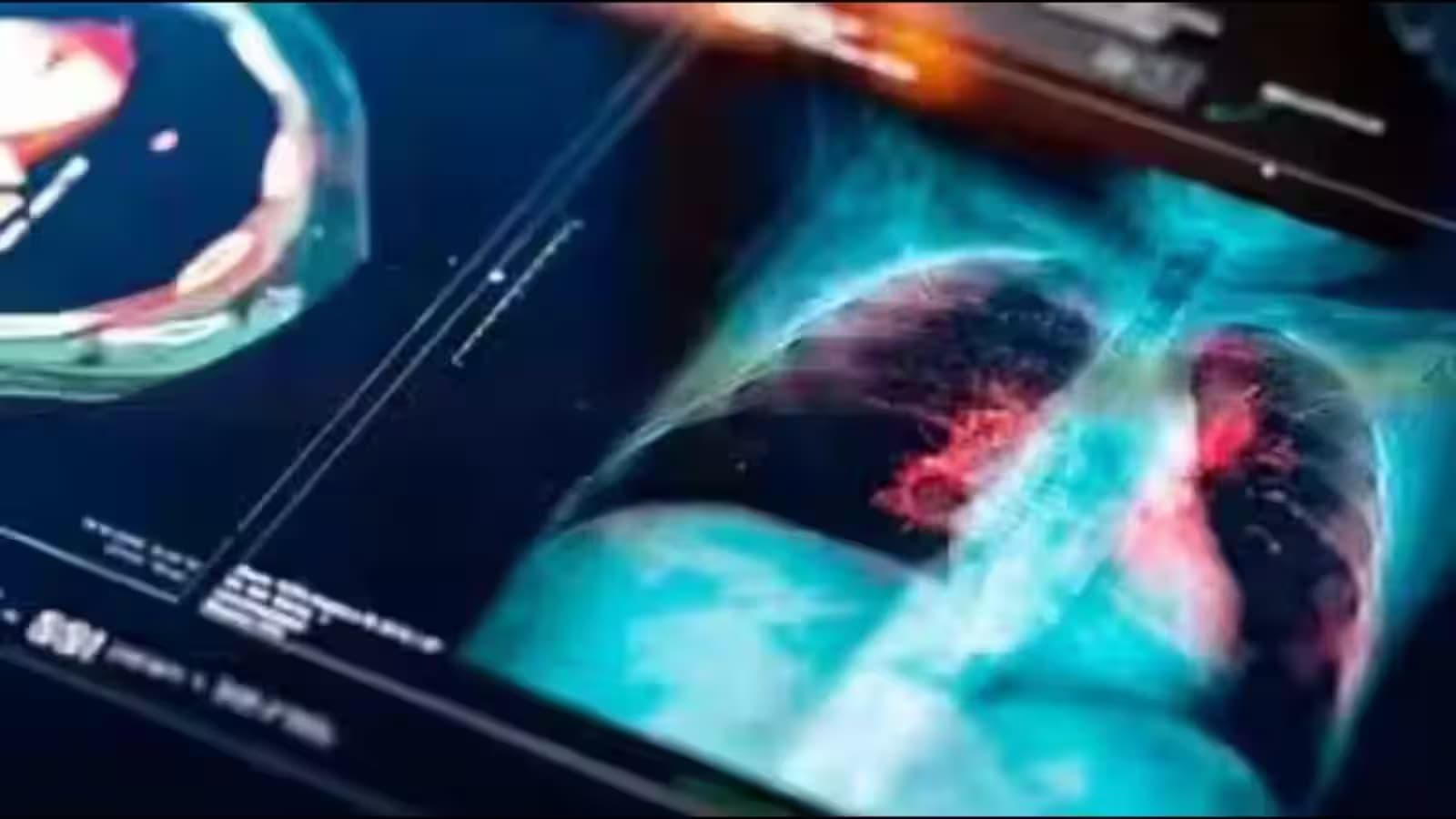 Lung Cancer Screening Challenges in India